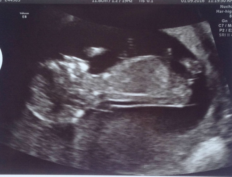 Baby nuchal scan picture